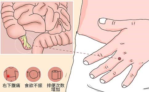 得了阑尾炎，临床上都会有哪些症状表现呢？