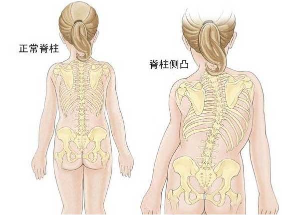 你了解导致儿童脊柱会发生侧弯的几个原因吗？